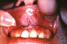 Dental discoloration